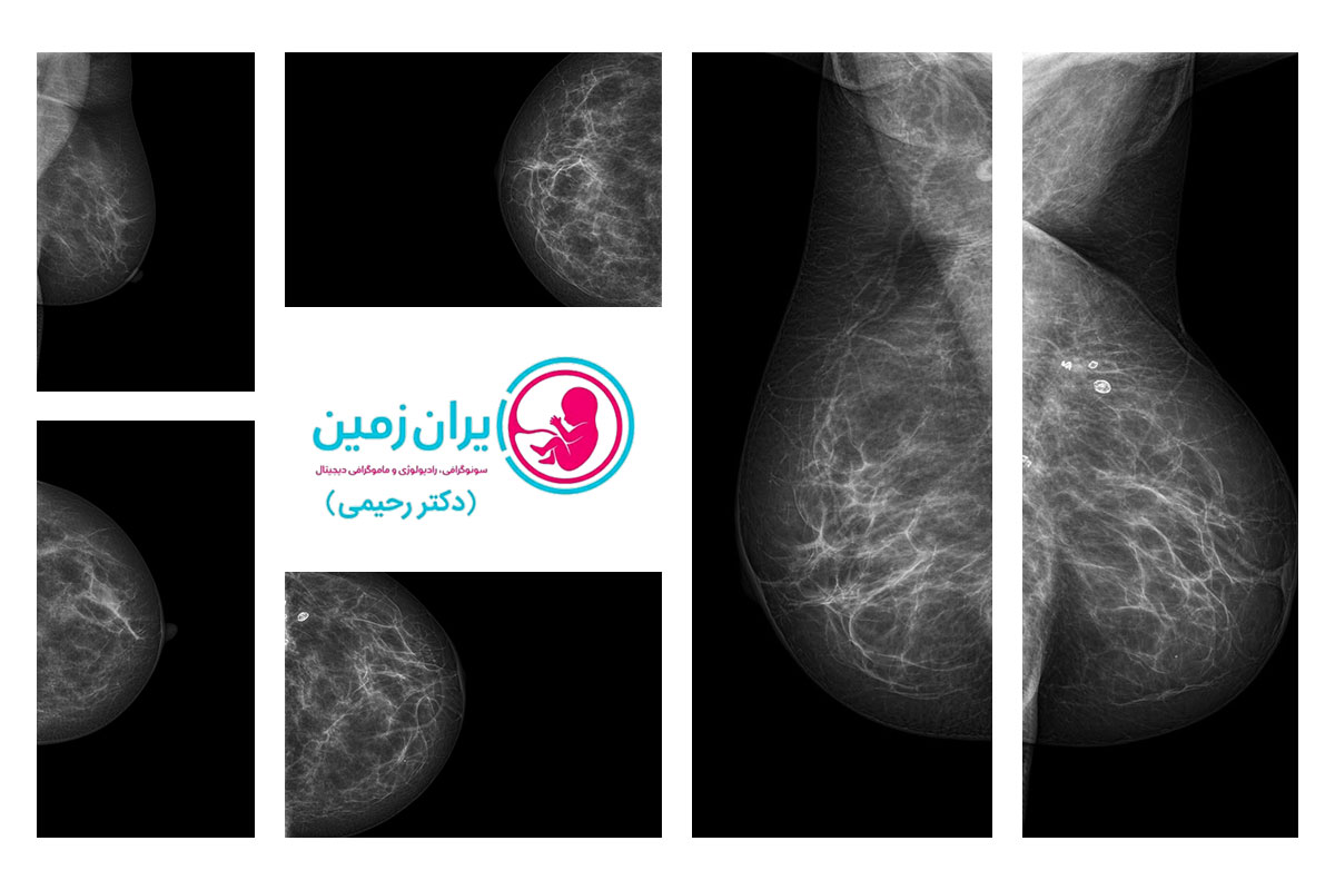 ماموگرافی بیماران مختلف