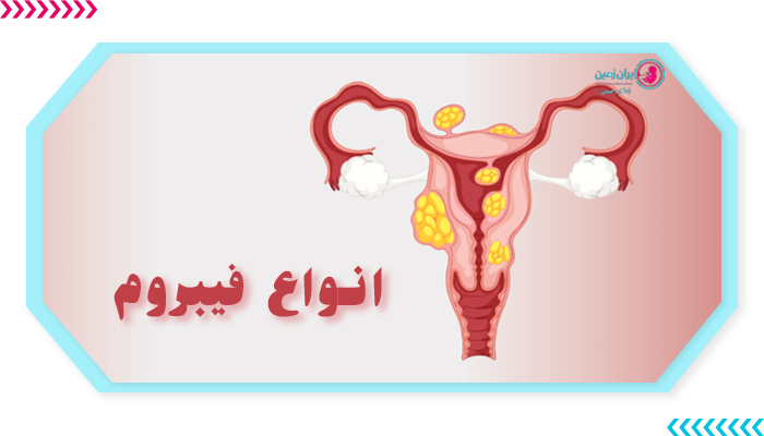 انواع فیبروم رحمی