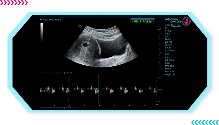 اهمیت سونوگرافی در هفته دوازدهم بارداری