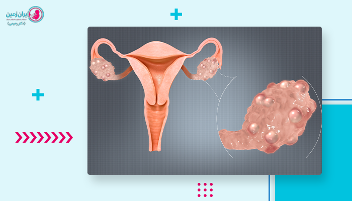 تخمدان پلی کیستیک و هر آنچه هر خانمی درباره آن لازم است بداند!